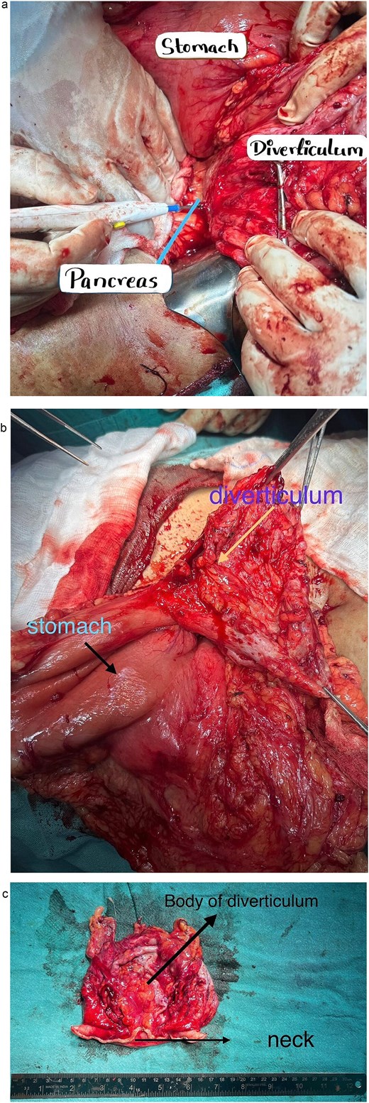 Intraoperative findings. (a) Gastric diverticulum attached to the posterior wall of stomach. (b) Gastric diverticulum attached to the posterior wall of stomach. (c) Gastric diverticulum following excision.
