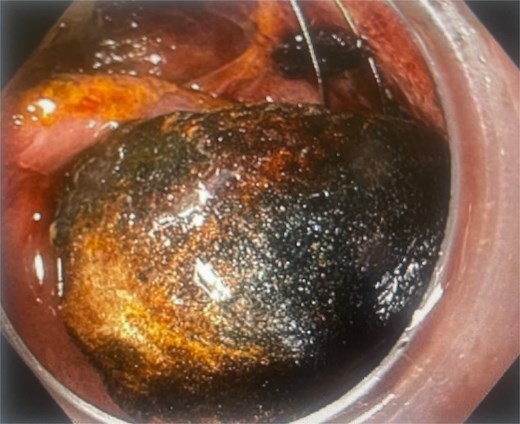 Gallstone trapped in a severed Dormia basket, with unsuccessful endoscopic retrieval.