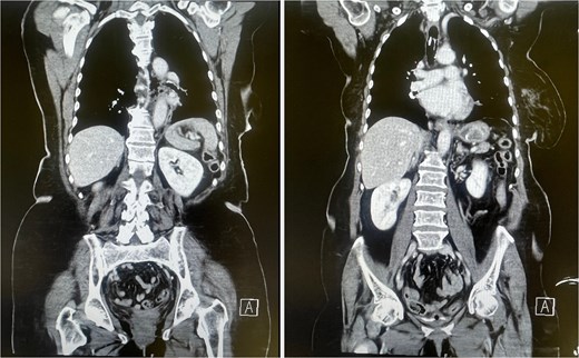 CT scan showing mediastinal air consistent with esophageal perforation (left) and a hyperdense structure in the stomach corresponding to the gallstone within the Dormia basket (right).