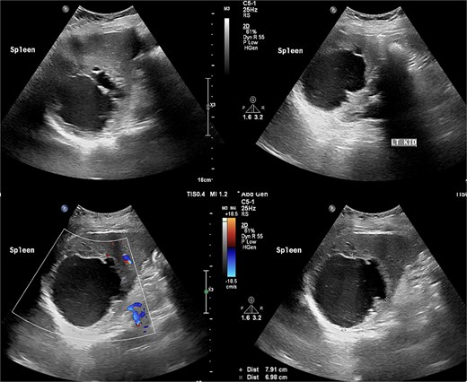 Abdomen ultrasound revealed well-defined multilocular cystic lesion with internal echoes in the spleen, measuring ~7.9 × 6.9 cm.