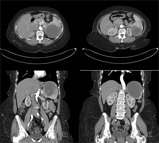 Abdominal and pelvic CT scan revealed a large, non-enhancing hypodense cystic lesion in the spleen with internal septations, calcifications, and multiple smaller daughter cysts arranged peripherally. Prime differential was type II hydatid cyst.