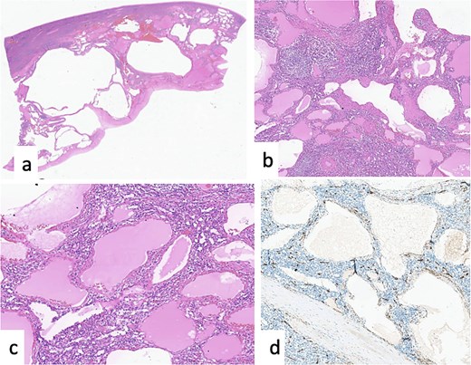 Cystic lymphangioma of the spleen. (a) HE × 20: ill-defined cystic lesion. (b, c) HE × 40, HE × 100: vessels of different caliber and shape filled by eosinophilic materiel. (d) Positivity of CD34 in the endothelial cells lining the lymphatic vessels.