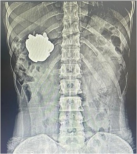 Plain abdominal X-ray (anteroposterior view) showing a large metallic foreign body projected over the left upper quadrant, corresponding to the stomach. The object has well-defined borders and dense radiopacity, consistent with an ingested metallic component.