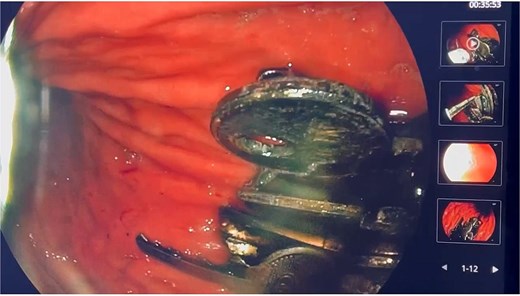 Flexible upper gastrointestinal endoscopy showing multiple metallic foreign bodies consistent with keys lodged within the gastric mucosa, associated with minor ulcerations in the gastric cardia and body.