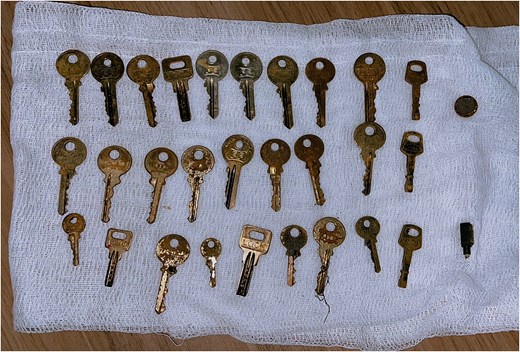 Gross photograph showing multiple metallic foreign bodies (keys and small metallic objects) laid out on gauze following endoscopic retrieval from the stomach.