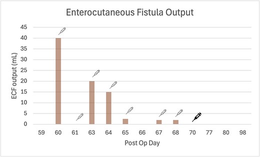 Bar graph of ECF output measurements, where Octreotide 100 μg subcutaneous three times daily injection was re-introduced post op Day 60 (as indicated by fine line syringe icon), and was switched to Lanreotide 60 mg subcutaneous injection post op Day 70 (as indicated by bold line syringe icon). The quality of the ECF fluid was enteric.