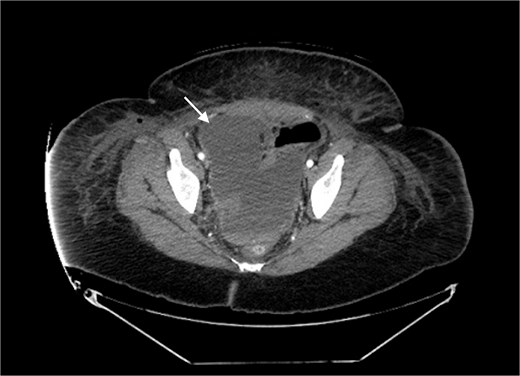 Pelvic fluid collection prior to IR drainage measuring 15.4 × 10.6 cm, in the axial view.