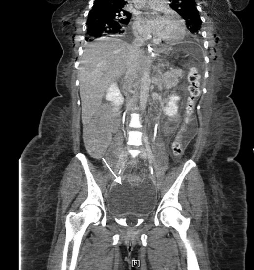 Pelvic fluid collection prior to IR drainage measuring 15.4 × 10.6 cm, in the coronal view.