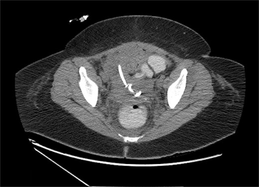Pelvic fluid collection on upsizing IR drain from 8.5 to 12 Fr, measuring 10.7 × 7.7 cm prior to tPA-dornase instillation, in the axial view.