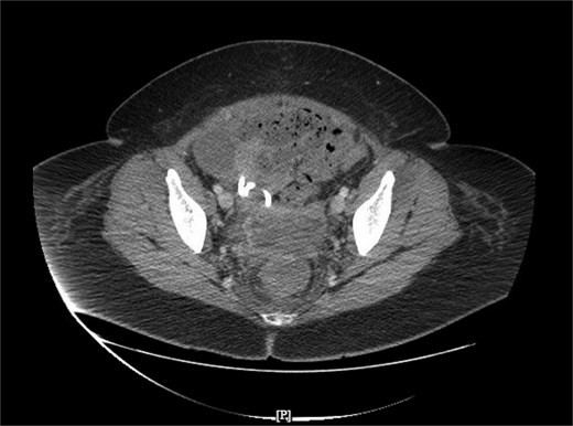 Resolution of pelvic fluid collection with 12 Fr catheter in place, in the axial view.