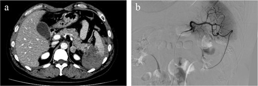 Hemorrhagic ascites were observed primarily around the spleen, suggesting splenic rupture. No contrast extravasation was observed and active bleeding was not suspected (a). Angiography showed no active bleeding or splenic artery aneurysms were observed on angiography (b).