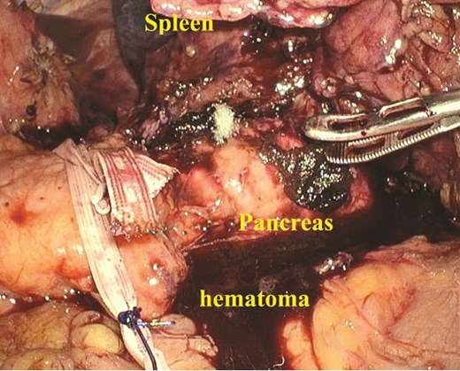 A large amount of hematoma was detected within the abdominal cavity. Owing to the hematoma, dense adhesions were formed between the spleen and surrounding tissues.