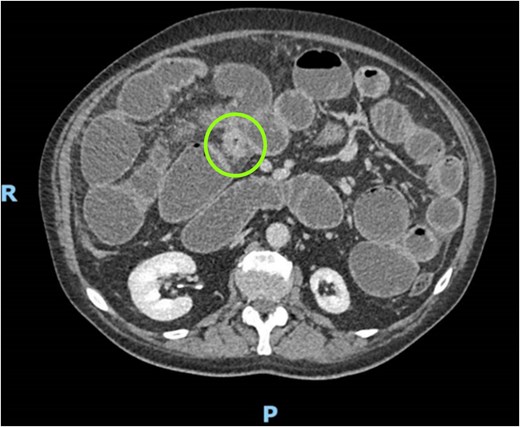 CT scan demonstrating concentric stenosis (circle) and dilated small bowel.