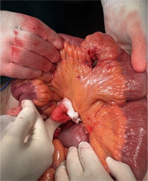 Intraoperative findings.