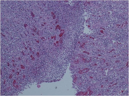 Histopathological examination of the resected specimen.