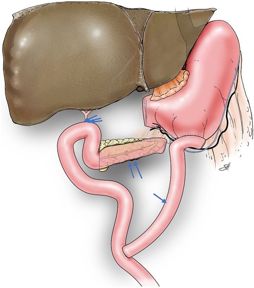 Alt text: Illustration depicting the reconstruction of a Roux-en-Y forty-five centimeter proximal gastrojejunal anastomosis, distal side-to-side pancreatojejunostomy, and fifty-centimeter hepaticojejunostomy after pyloric ring resection pancreaticoduodenectomy.
