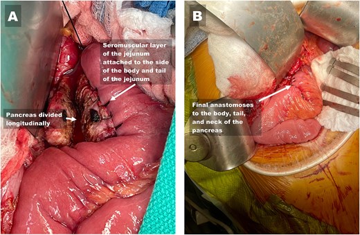 Alt text: Two images depicting the reconstruction of the side-to-side pancreatojejunostomy to the body, tail, and neck of the pancreas. The first image shows the divided main pancreatic duct after completion of the first layer of the side-to-side pancreatojejunostomy and the neck of the pancreas. The second image shows the completed two-layered anastomosis.