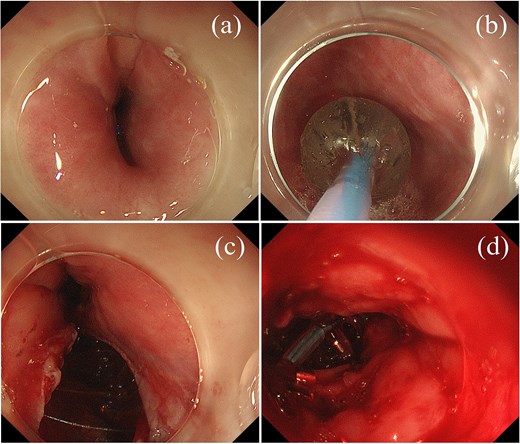 Endoscopic findings. (a) Upper gastrointestinal endoscopy showing esophageal stricture. (b) Balloon dilation procedure. (c) Perforation observed on the left side of the esophagus during the second dilation. (d) Unsuccessful endoscopic closure attempt using metallic clips.