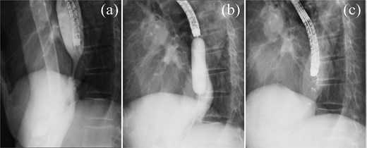 Esophagography. (a) Esophagography revealing esophageal stricture. (b) Balloon dilation procedure. (c) Attempted endoscopic closure of the esophageal perforation with clips.