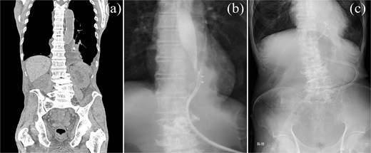 Postoperative imaging and monitoring. (a) Chest and abdominal CT scan demonstrating mediastinal abscess formation. (b) Contrast study through drainage tube revealing communication with the esophagus. (c) Chest radiographs monitoring pulmonary status and drain positioning.