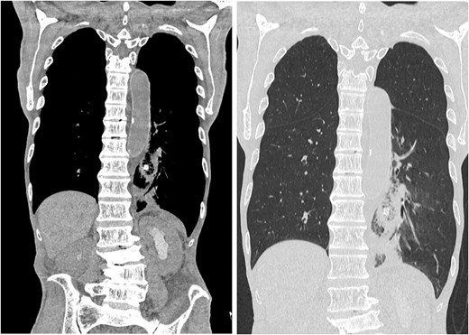 Postoperative drain migration. Chest and abdominal CT scan showing drain tip migration into the thoracic cavity.