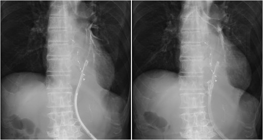Bronchoperitoneal fistula formation. Contrast study through drainage tube demonstrating a fistula between the bronchus and peritoneal cavity.