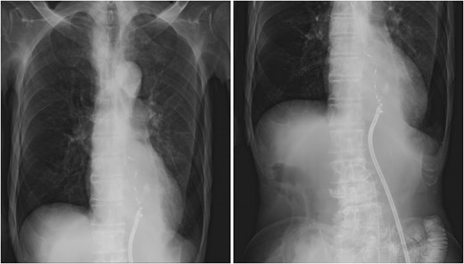 Drain repositioning. Chest radiograph and contrast study showing drain tip repositioning into the mediastinum.