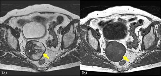 Pelvic MRI imaging. A 6 cm diameter solid mass is found in the right pelvic wall and is suspected to be an ovarian fibroma and Brenner tumor. T2-weighted image, a multilocular high signal, and fluid accumulation are revealed (arrow) (a). The same area is slightly detected as a high signal in the T1-weighted image (arrow) (b), and a mucinous tumor is also suspected.