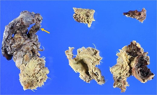 Surgical specimen. The presence of gauze-like fibrous tissue is noted accompanying the granuloma (arrow).