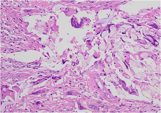 Microscopic examination showed by H&E × 200 staining. Foreign body granuloma containing a piece of gauze and giant cells.