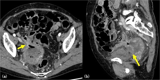 Abdominal CT imaging. Axial CT image showing intralesional air within the gossypiboma, indicating communication with the small intestine (arrow) (a). Sagittal CT image demonstrating fluid collection between the mass and the bladder, consistent with abscess formation secondary to rupture (arrow) (b).