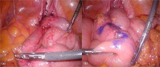 Intra-abdominal findings. The right side of the image corresponds to the patient’s right side. Looped small bowel segments are clustered along the right pelvic peritoneum, and despite adhesiolysis, the entirety of the gossypiboma could not be identified (a). The site for stoma creation is marked ~10 cm proximal to the afferent limb of the loop (b).