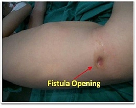 Preoperative photograph showing a right flank appendicocutaneous fecal fistula.