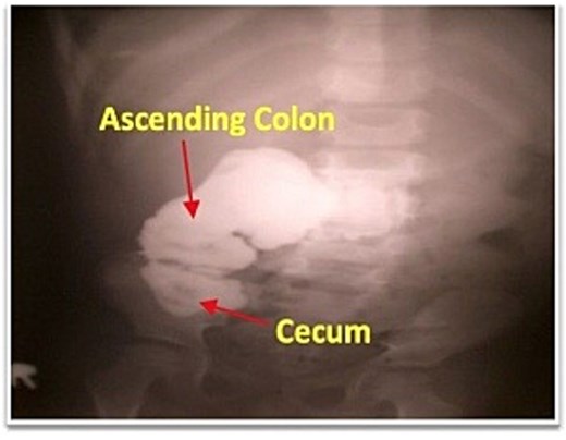 Fistulogram demonstrating contrast entering the cecum and right colon.