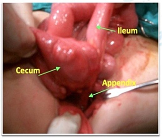 Intraoperative photograph showing the appendix traversing the fistula tract.