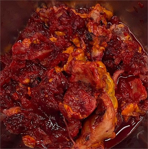 A specimen of adrenal gland extracted by laparoscopic adrenalectomy.