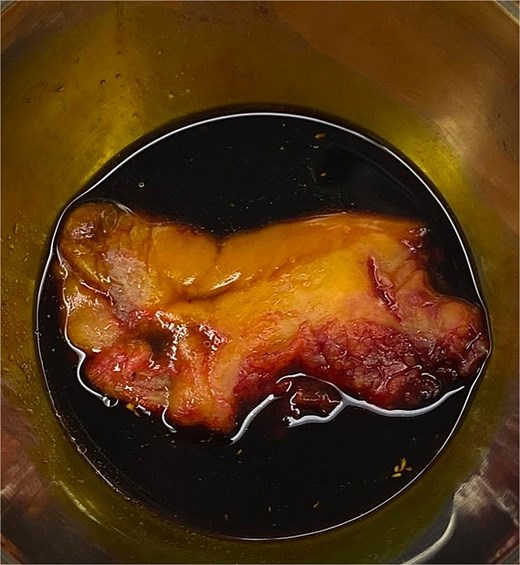 A specimen of gull bladder extracted by laparoscopic cholecystectomy.