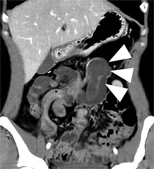 Contrast-enhanced CT demonstrating ileocecal intussusception with a 34-mm cystic lesion at the lead point, indicated by arrows, consistent with an appendiceal mucocele on coronal view.