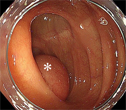 Endoscopic findings after reduction. The asterisk marks the intussuscepted segment, which returned to the cecum with gentle insufflation. The cushion sign was positive, and the cystic lesion appeared contiguous with the appendiceal orifice.