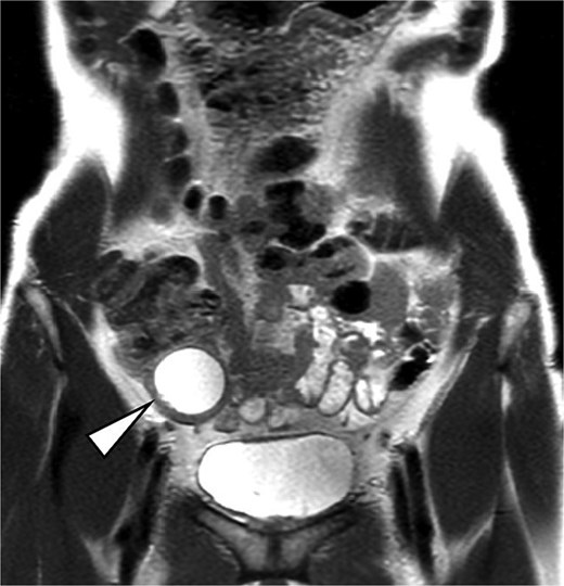 MRI image. The arrow indicates a well-circumscribed cystic lesion in the ileocecal region without mural nodules or solid components.
