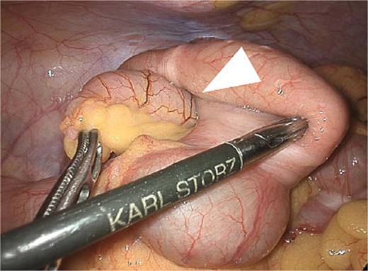 Laparoscopic intraoperative view showing the appendix invaginated into the cecum. The arrow indicates the invaginated appendix. The lesion was not exposed, allowing ileocecal resection without direct tumor manipulation.