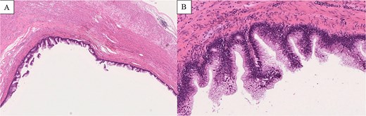 Histopathological findings (H&E staining). (A) Low-power view (×2 objective) shows a cystically dilated mucinous lesion in the appendix. (B) Medium-power view (×10 objective) shows mucin-producing epithelium with low-grade cytologic atypia, consistent with LAMN.