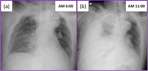 Postoperative chest X-ray: (a) Chest X-ray on the morning after surgery showed the expected postoperative changes. (b) The patient suddenly complained of dyspnea, and a large amount of bloody effusion drained from the chest tube after mobilization. The chest X-ray showed a large amount of effusion.