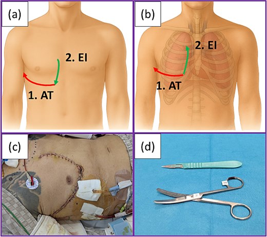 Procedure for resuscitative thoracotomy: (a) Skin incisions made in the present case. Anterolateral thoracotomy was first performed (1), followed by an extended incision directed caudally from the cephalad side according to the hand orientation with the scalpel (2). (b) Extended incision followed by transection of the cartilages was performed with scissors in a caudal-to-cranial direction (2). (c) Postoperative wound of the patient. (d) Only a scalpel and scissors were used to perform resuscitative thoracotomy in the present case. Abbreviations: AT: Anterolateral incision; EI: Extended incision.