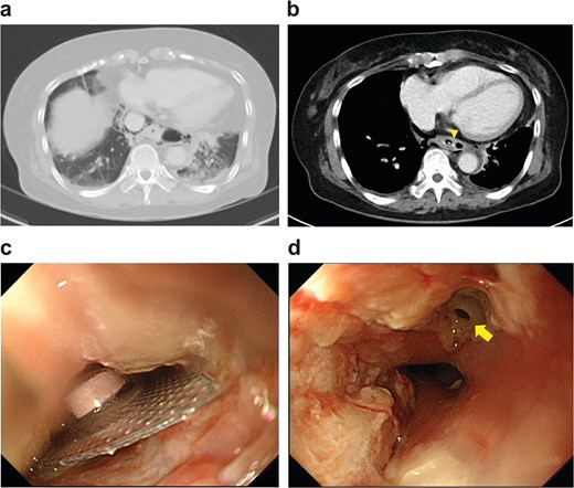 Lung and mediastinal window chest CT showing a radiopaque foreign body lodged in the lower thoracic esophagus. Endoscopy reveals an impacted blister pack, with a small esophageal perforation visible after removal.