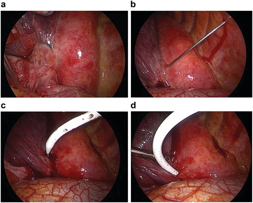 Thoracoscopic view of a focal bulging mass along the lower esophagus. A 14-Fr pigtail catheter is introduced into the abscess cavity using the Seldinger technique.