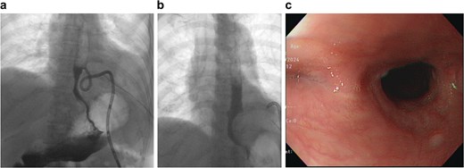 Oral contrast esophagography on PODs 30 and 49 showing resolution of leakage. Follow-up endoscopy at three months confirms complete healing without stricture.