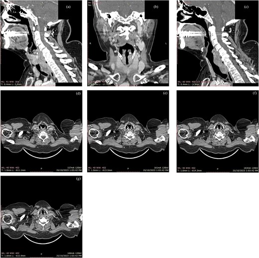 Contrast-enhanced CT scan of the neck demonstrating a left posterior subglottic mass with inferior extension into the proximal trachea. Sagittal (a, b) and coronal (c) reformats illustrate the craniocaudal extent. Sequential axial images (d–g) demonstrate eccentric left posterolateral subglottic/proximal tracheal wall thickening with luminal narrowing and extension into the adjacent left paratracheal soft tissues/tracheoesophageal groove region.