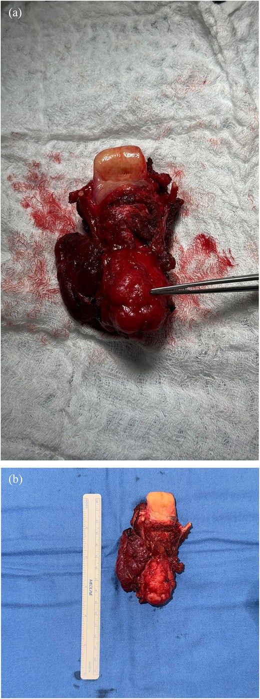 Gross specimen and histopathologic features of resected ACC. (a) Anterior view; (b) posterior view.