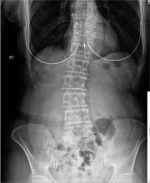 AP abdominal radiograph. The image reveals a non-obstructive bowel gas pattern. There is significant fecal loading of the colon, consistent with constipation or slow colonic transit. No evidence of small bowel obstruction or perforation is seen.